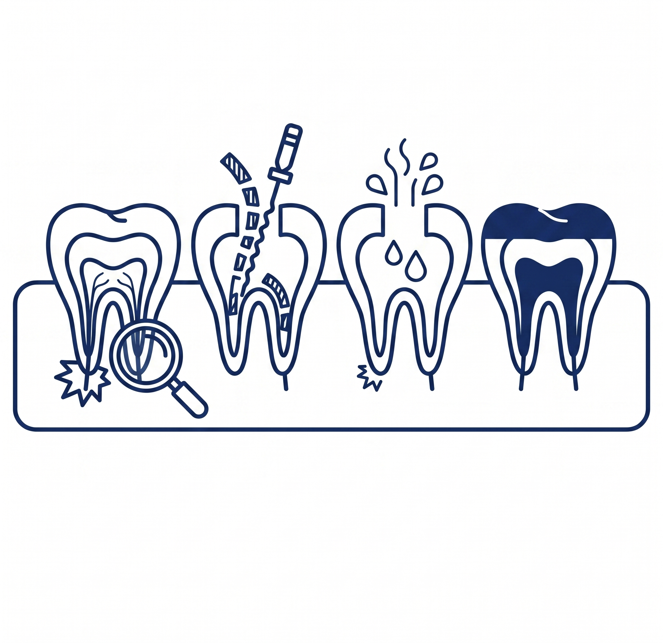 Diagram illustrating endodontic retreatment — identifying failed root canal treatment, removing existing filling material, re-disinfecting the canals, and re-obturation with bioceramic materials