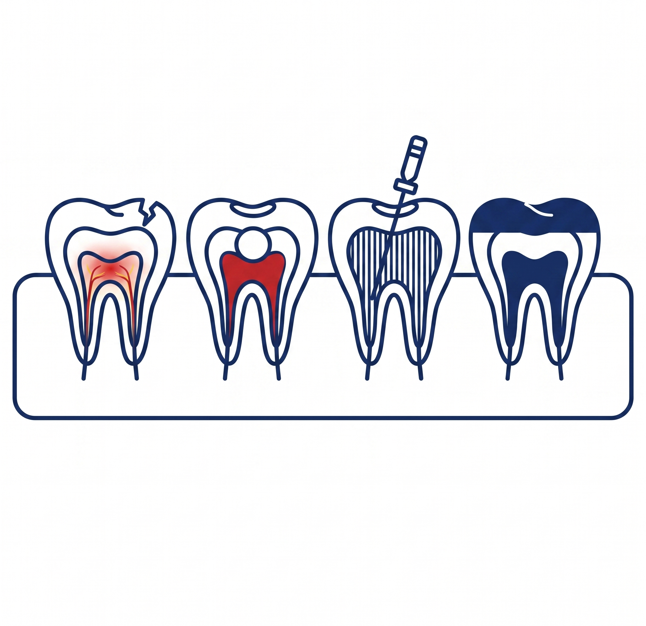 Diagram illustrating the stages of root canal treatment — diagnosis of tooth infection, canal instrumentation, irrigation, and final obturation by a specialist endodontist